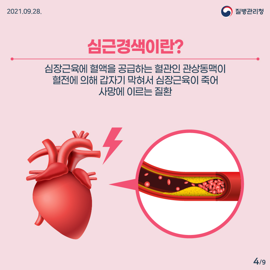 2021년 9월 28일 질병관리청 심근경색이란? 심장근육에 혈액을 공급하는 혈관인 관상동맥이 혈전에 의해 갑자기 막혀서 심장근육이 죽어 사망에 이르는 질환 9페이지 중 4페이지